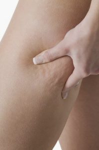 Celulitis, Qué Es y Cuáles Son sus Síntomas-SaludAhora