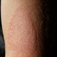 Dermatitis Atópica: Por Qué Aparece y Cómo Tratarla-SaludAhora