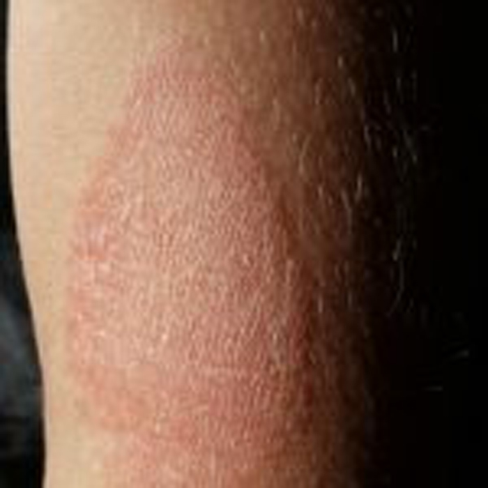 Dermatitis Atópica: Por Qué Aparece y Cómo Tratarla-SaludAhora