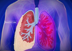 What is mesothelioma-SaludAhora.info