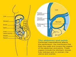 What is mesothelioma-SaludAhora.info