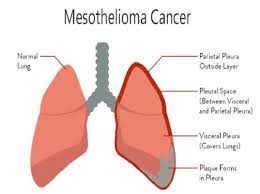 What is mesothelioma-SaludAhora.info