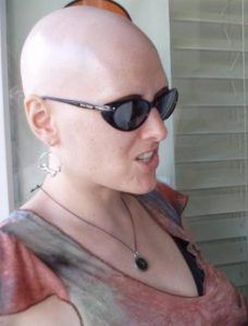 Qué Es la Alopecia